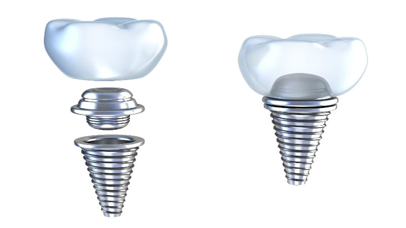 Dental Implant Services in Queens, NY, Offer Impressive Results