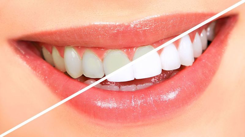 Everything You Need to Know About Having a Tooth Pulled