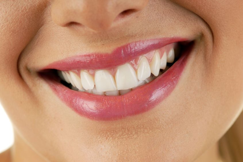 Change Your Life with Dental Veneers in Lumberton, TX