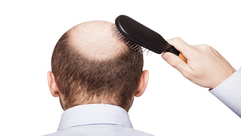 3 Benefits of Undergoing FUE Hair Transplant in Philadelphia, PA