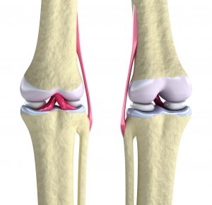 Getting Facts You Need about Knee Replacement Surgery in Scottsdale, AZ