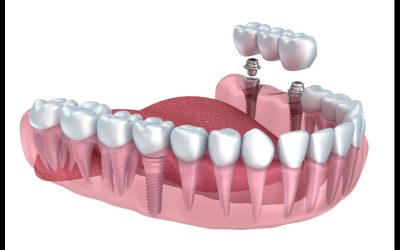 Transform Your Smile with Dental Implants in Dayton: The Ultimate Tooth Replacement Option